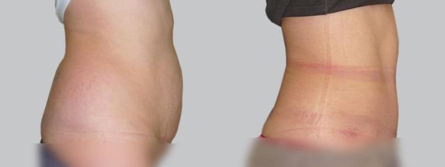 Abdominoplastika - Asklepion
