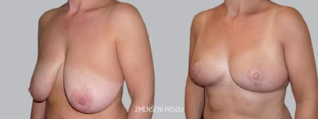 Zmenšení prsou - Asklepion