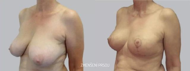 Zmenšení prsou - Asklepion