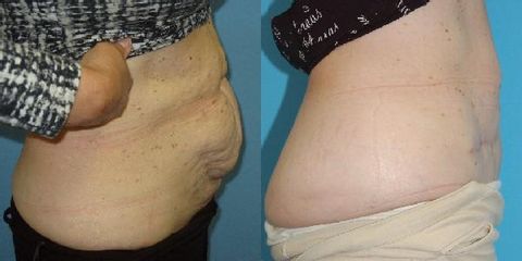 abdominoplastika pred