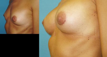 aug pre op 2