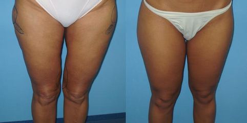 lipo pre op1