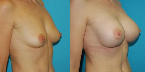 augmentace pre op 7