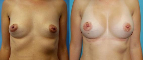 augmentace pre op 8