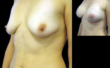 augmentace pre op 11