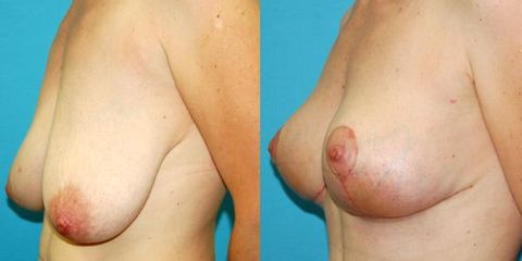 redukce pre op 1 1