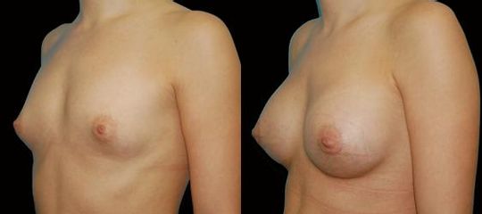 augmentace pre op 15