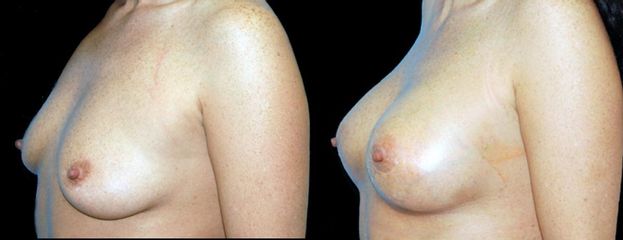 augmentace pre op 17jpg