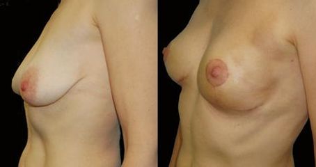 modelace pre op