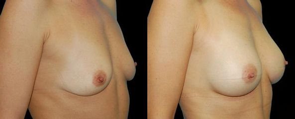 augmentace pre op 19