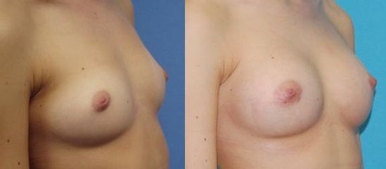pre op 1 1