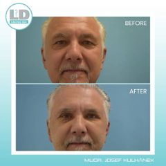 Facelift - MUDr. Josef Kulhánek MBA