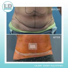 Abdominoplastika - MUDr. Josef Kulhánek MBA