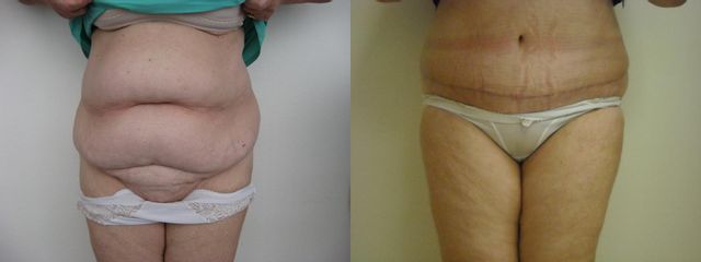 Abdominoplastika - MUDr. Suk Marek