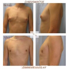 Gynekomastie - ART ETHIC CLINIC