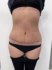 Abdominoplastika - Prim. MUDr. Martin Chorvát - Venusium Clinic