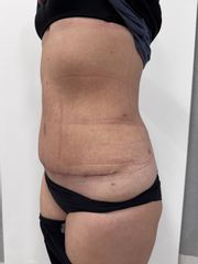 Abdominoplastika - Prim. MUDr. Martin Chorvát - Venusium Clinic
