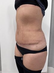 Abdominoplastika - Prim. MUDr. Martin Chorvát - Venusium Clinic