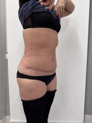 Abdominoplastika - Prim. MUDr. Martin Chorvát - Venusium Clinic