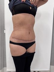 Abdominoplastika - Prim. MUDr. Martin Chorvát - Venusium Clinic