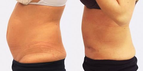 chl abdominoplastika christodolou bok pred