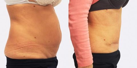 chl abdominoplastika christodolou bok2 pred