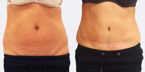 chl abdominoplastika christodolou zepredu pred
