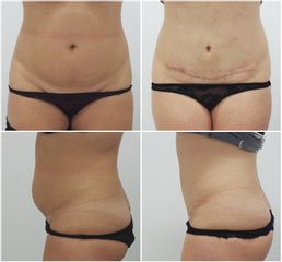 Abdominoplastika - MUDr. Petros Christodoulou - MEDICOM Clinic