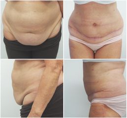 Abdominoplastika - MUDr. Petros Christodoulou - MEDICOM Clinic