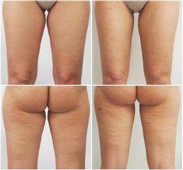 Liposukce - MUDr. Petros Christodoulou - MEDICOM Clinic