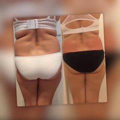 Liposukce - Swiss Esthetic