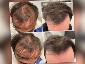 Léčba vypadávání vlasů pomocí plazmaterapie - 841707