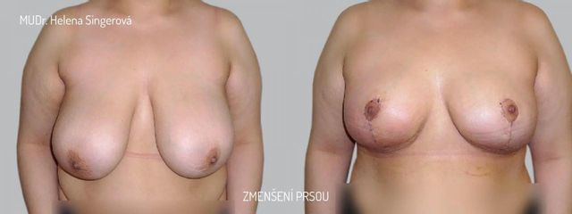 BEFORE mamaplastika 2
