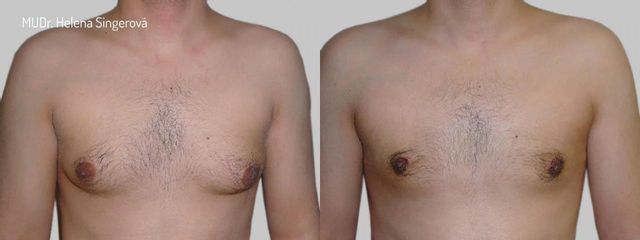 BEFORE gynekomastie B