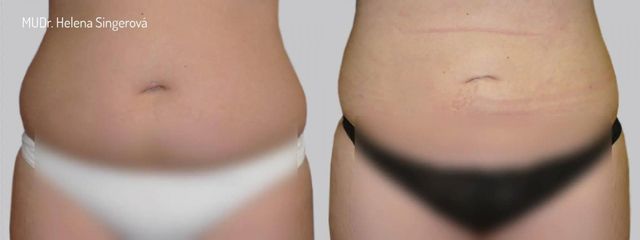 BEFORE liposukce 4 01