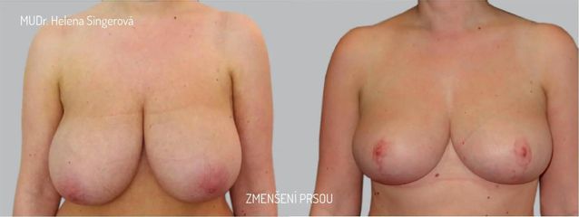 BEFORE mamaplastika 3