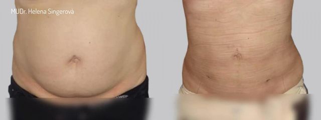 BEFORE liposukce 5 01