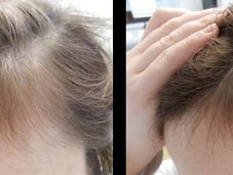 Léčba vypadávání vlasů pomocí plazmaterapie - 731293