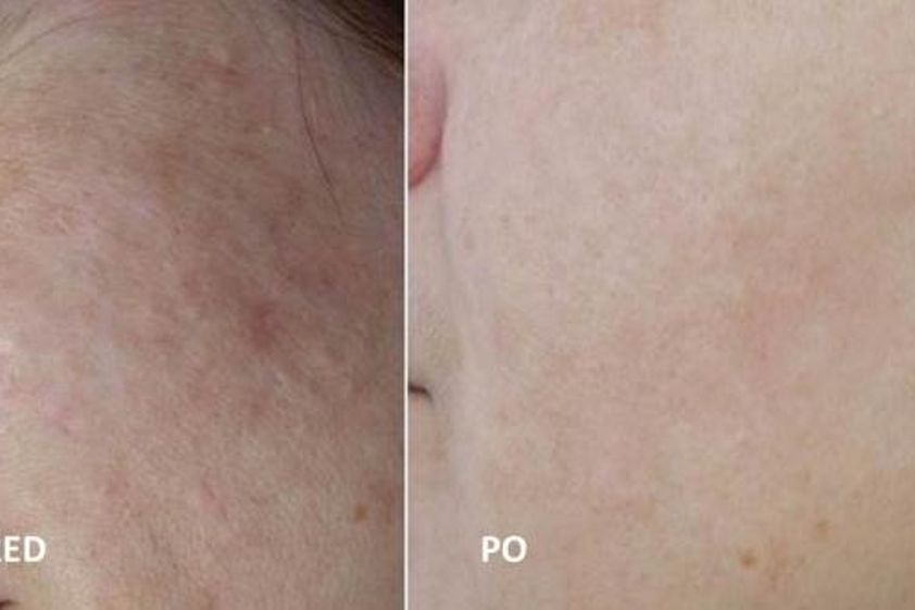 Microneedling před a po - 731295