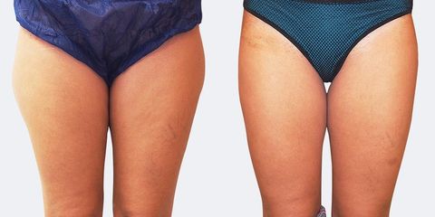 jz laserlipo zevnich stehen zepredu pred