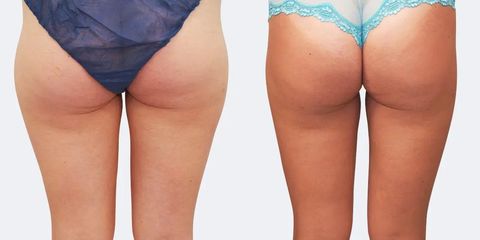 SlimLipo zevních stehen