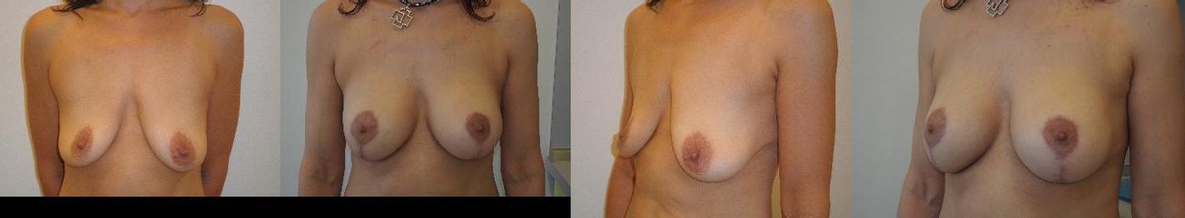 Augmentace včetně modelace