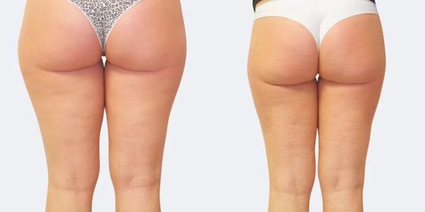 Laserová liposukce zevních stehen
