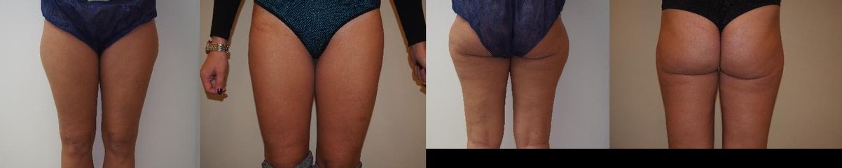 Liposukce LipoDefine zevních stehen