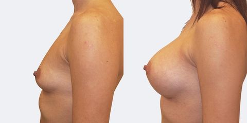 1 pouziti anatomickych implantatu bok pred