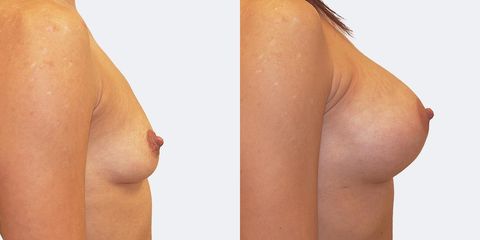 1 pouziti anatomickych implantatu bok2 pred