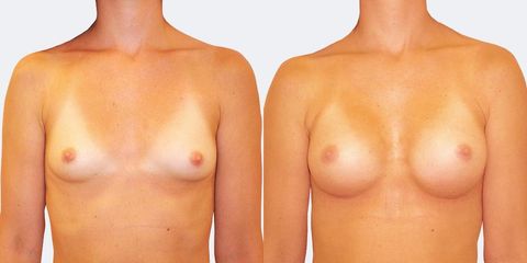 12 plasticka chirurgie prirozene zvetseni zepredu pred