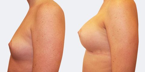 1 plasticka chirurgie prirozene zvetseni bok pred