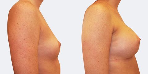 1 plasticka chirurgie prirozene zvetseni bok2 pred