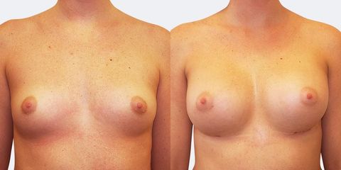1 plasticka chirurgie prirozene zvetseni zepredu pred